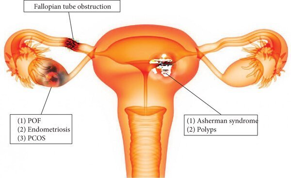 Diagram-showing-some-possible-causes-of-female-infertility-such-as-fallopian-tube.jpg